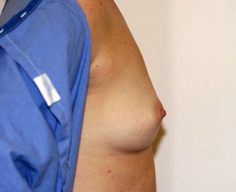 Breast Augmentation Case 15 - before - side