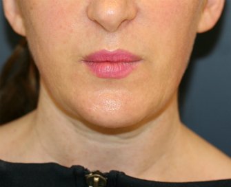 Lipo Lower Face, Neck, & Chin Implant - after - front