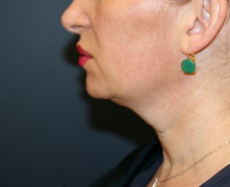 Lipo Lower Face, Neck, & Chin Implant - before - side
