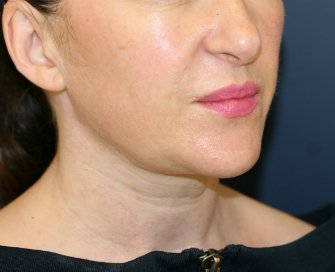 Neck and Lower Face Lipo - after - oblique
