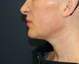 Neck and Lower Face Lipo - after - side