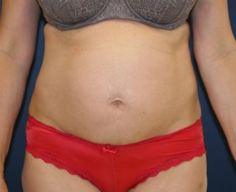 Tummy Tuck (3 kids) - before - oblique