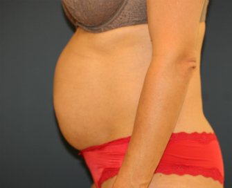 Tummy Tuck (3 kids) - before - side