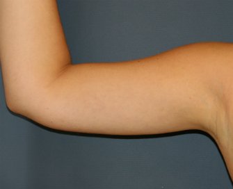 Arm Lipo-Reduction San Diego - after - front