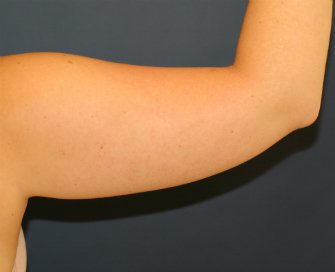 Arm Lipo-Reduction San Diego - before - back