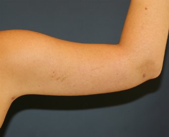 Arm Lipo-Reduction San Diego - after - back