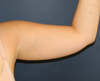Arm Liposuction San Diego - before - front
