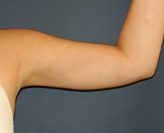 Arm Liposuction San Diego - after - front