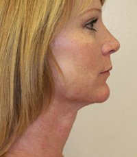 Necklift Case 2 - after - front