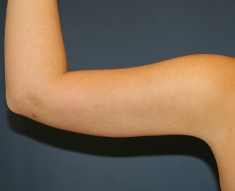 Arm Liposuction San Diego - after - back