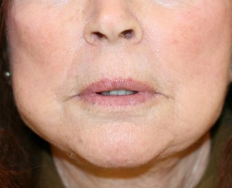 Permanent Lips San Diego - before - front