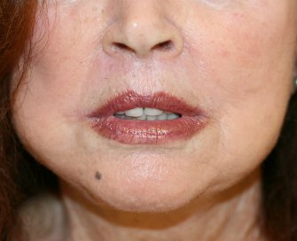 Permanent Lips San Diego - after - front