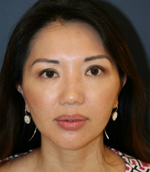 Asian Eyelid Crease - after - front
