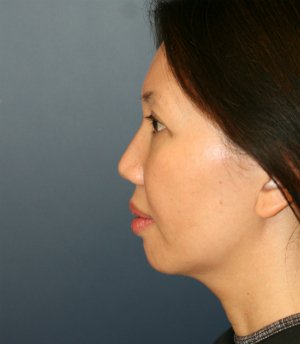 Chin, Nose, Eyelids - before - side