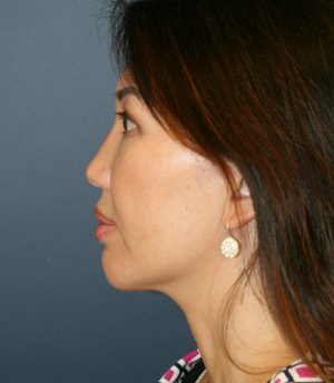 Chin, Nose, Eyelids - after - side