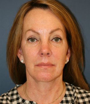 Face and Neck Procedure - after - front