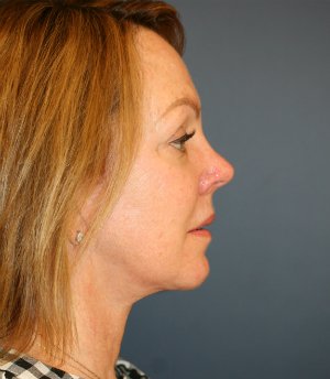 Face and Neck Procedure - after - side