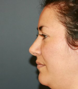 Rhinoplasty San Diego 70 - after - front