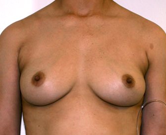 Breast Augmentation Case 16 - before - front