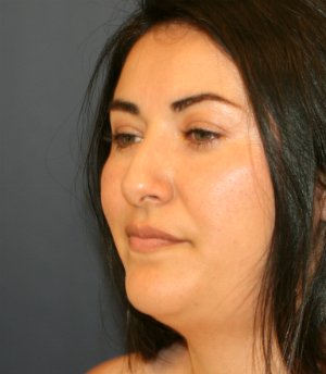 Rhinoplasty San Diego 70 - before - oblique