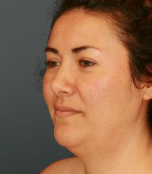 Rhinoplasty San Diego 70 - after - oblique