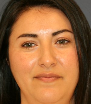 Rhinoplasty San Diego 70 - before - side