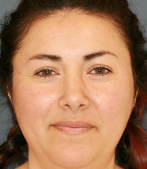 Rhinoplasty San Diego 70 - after - side
