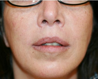 Upper Lip Lift 150 - after - front