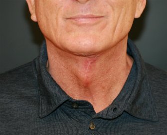 Neck Lift San Diego 36 - after - side