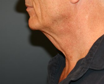 Neck Lift San Diego 36 - before - front