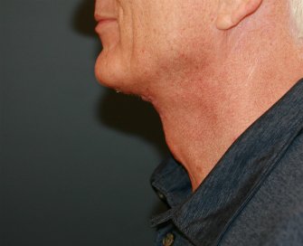 Neck Lift San Diego 36 - after - front