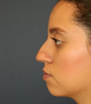 Rhinoplasty San Diego 71 - before - front