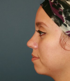 Rhinoplasty San Diego 71 - after - front