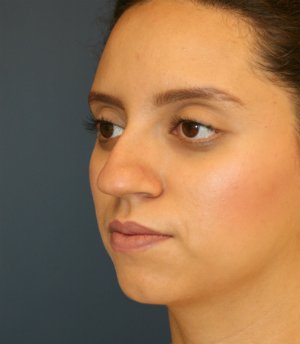 Rhinoplasty San Diego 71 - before - oblique