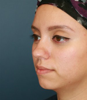 Rhinoplasty San Diego 71 - after - oblique