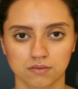 Rhinoplasty San Diego 71 - before - side