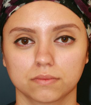 Rhinoplasty San Diego 71 - after - side