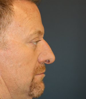 Rhinoplasty Male 72 - before - front
