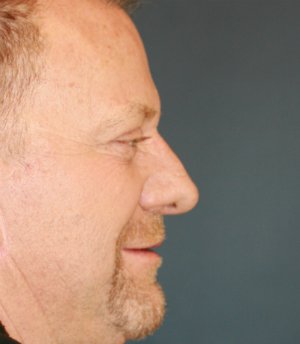 Rhinoplasty Male 72 - after - front