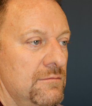 Rhinoplasty Male 72 - before - oblique