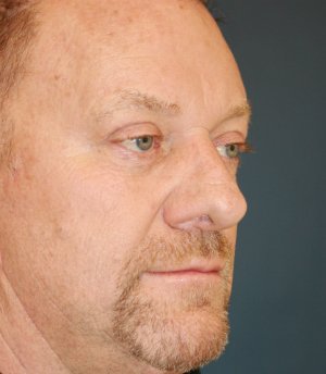 Rhinoplasty Male 72 - after - oblique