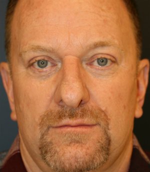 Rhinoplasty Male 72 - before - side