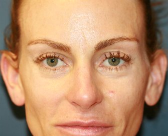 Procedure to Open Eyelids Slightly - before - front