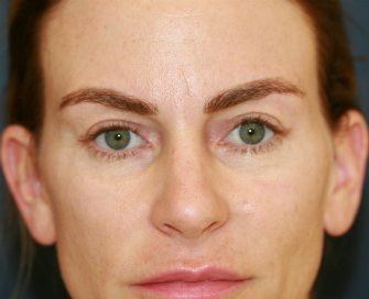 Procedure to Open Eyelids Slightly - after - front