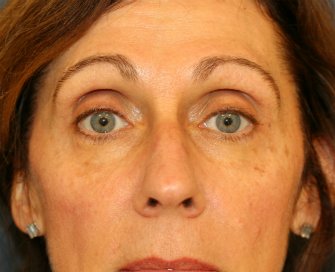 Eyelid Surgery San Diego 93 - before - front