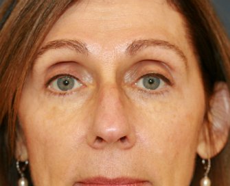 Eyelid Surgery San Diego 93 - after - front