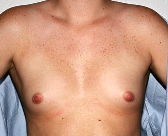 Breast Augmentation Case 17 - before - front