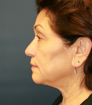 Face Lift San Diego 44 - before - side