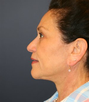Face Lift San Diego 44 - after - side