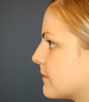 Rhinoplasty San Diego 73 - before - front